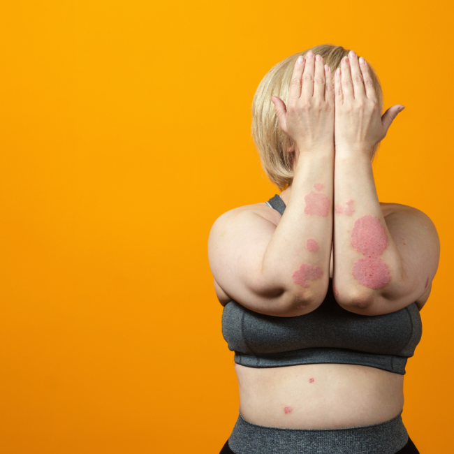 diatrofi gia psoriasi